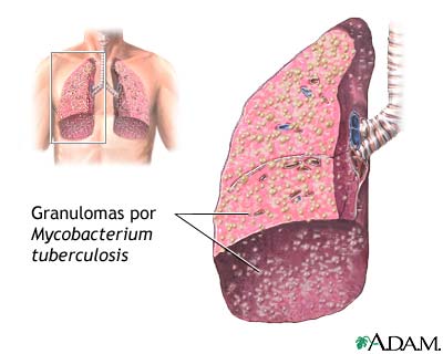 Ciencias de la Salud: Tuberculosis Pulmonar
